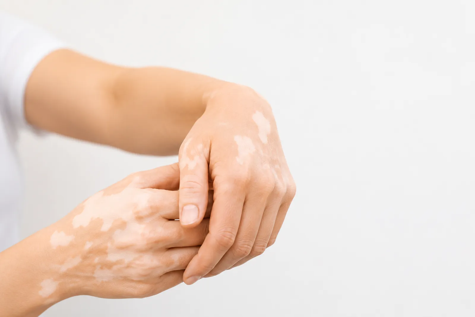 Pigmentation & Skin Imperfection Correction